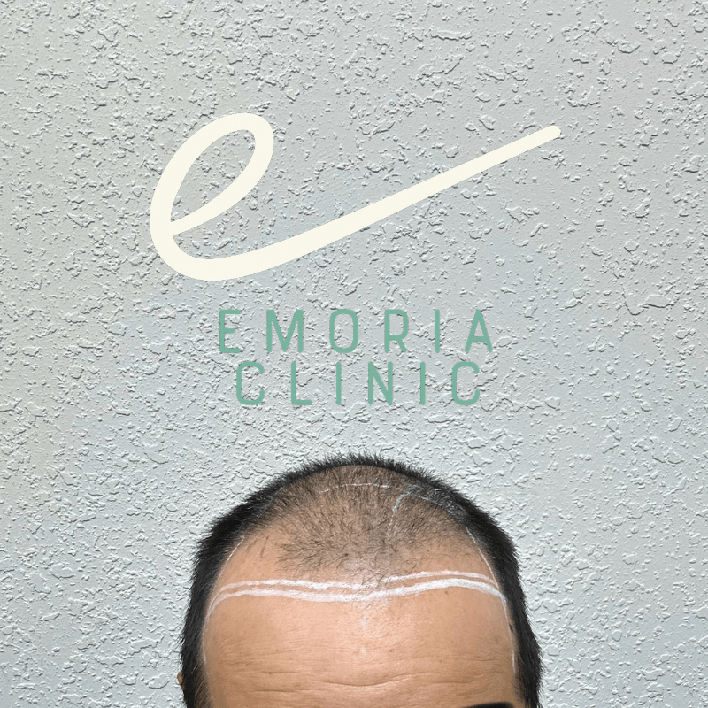 hair-transplant-clinic-image