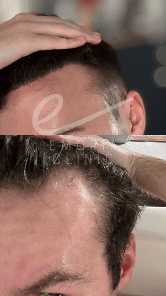 Before and After Picture of 2000 Grafts Hair Transplant