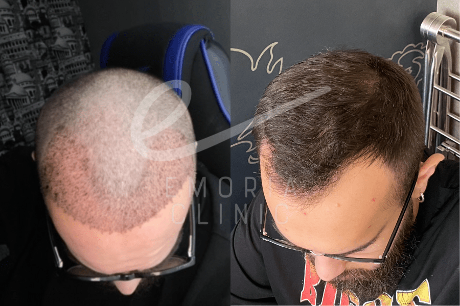 Before and After Picture of 2000 Grafts Hair Transplant