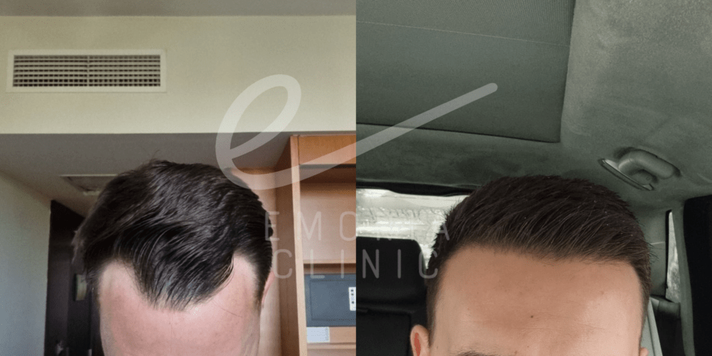 Before and After Picture of 2500 Grafts Hair Transplant
