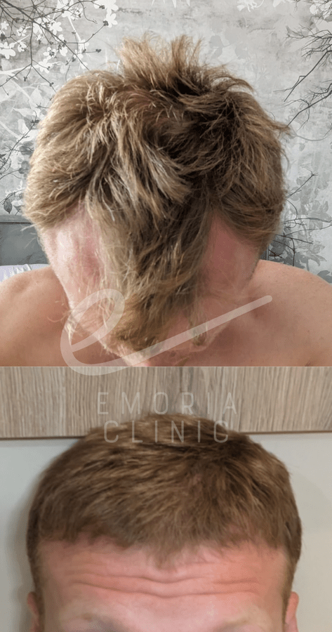 Before and After Picture of 3000 Grafts Hair Transplant