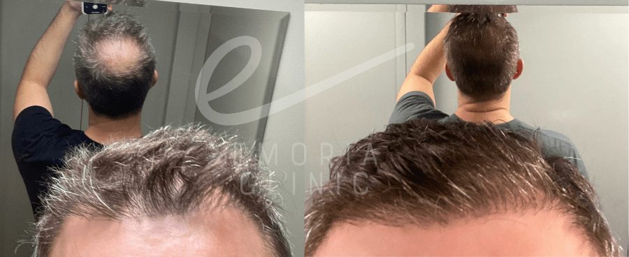 Before and After Picture of 4000 Grafts Hair Transplant