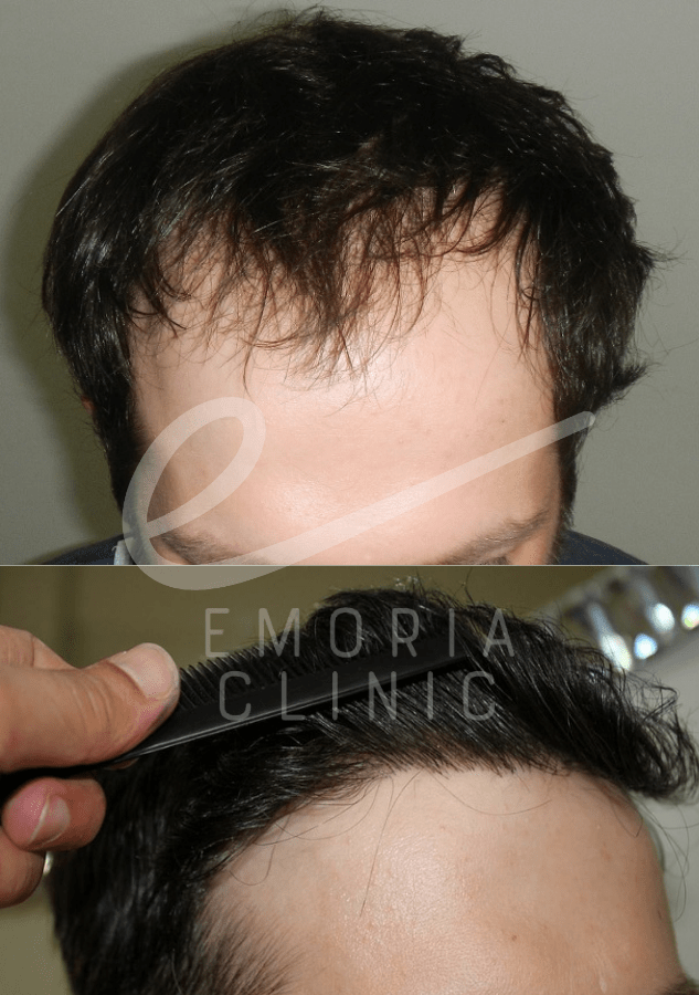 Before and After Picture of 4500 Grafts Hair Transplant