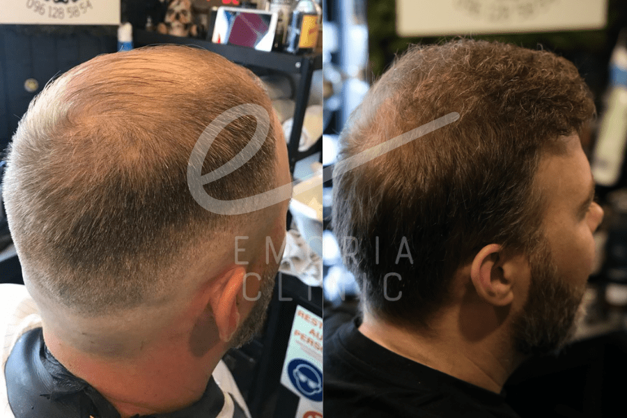 Before and After Picture of 5000 Grafts Hair Transplant
