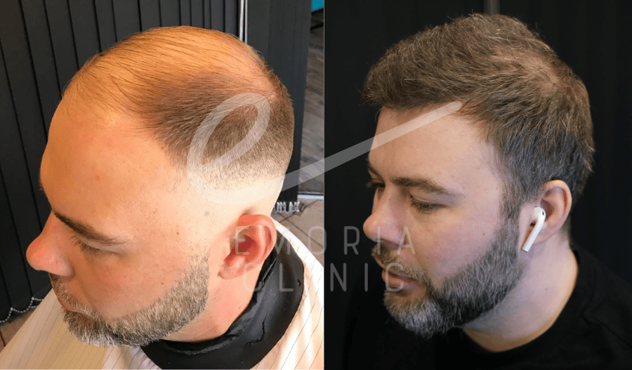 Before and After Picture of 5000 Grafts Hair Transplant