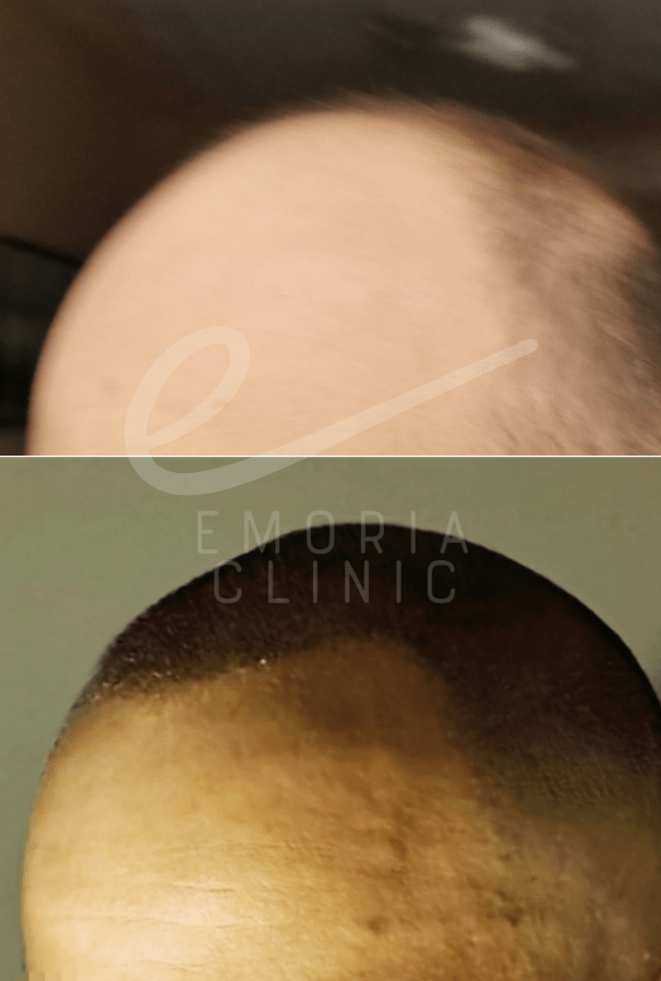 Before and After Picture of 6000 Grafts Hair Transplant