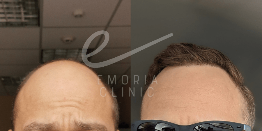 Before and After Picture of 6000 Grafts Hair Transplant