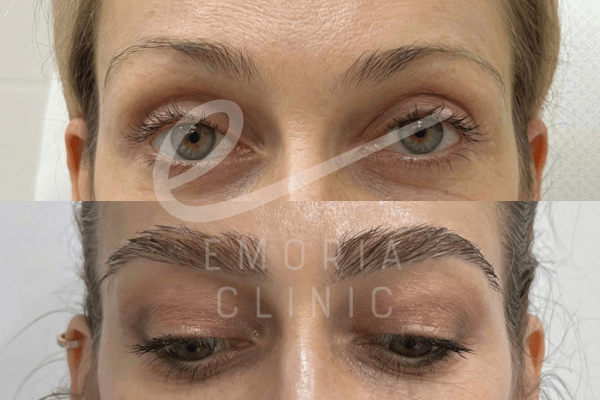 Before and After Picture of 200 Grafts Female Eyebrow Transplant