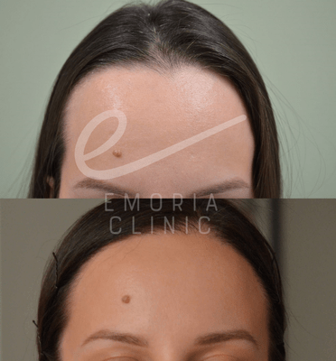 Female hair transplant before after 1500 graft