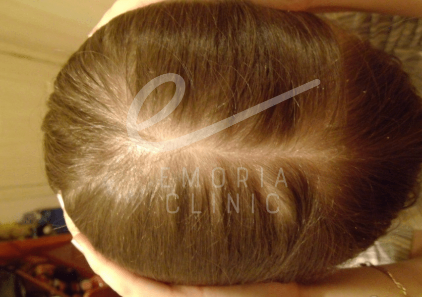 Effect of Female Alopecia on Hair Density