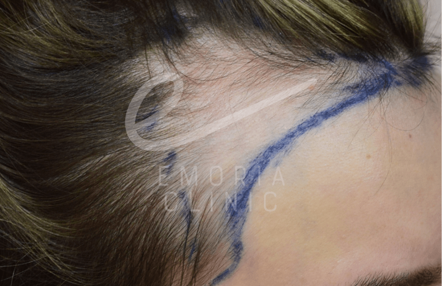 Female Hair Transplant Patient Before the Operation