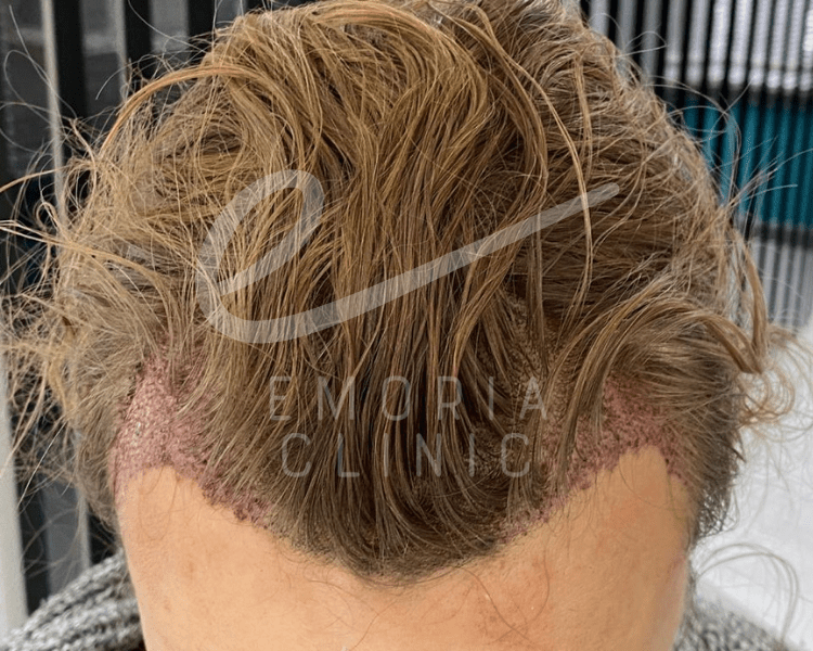 Female with Recent Unshaven Hair Transplant