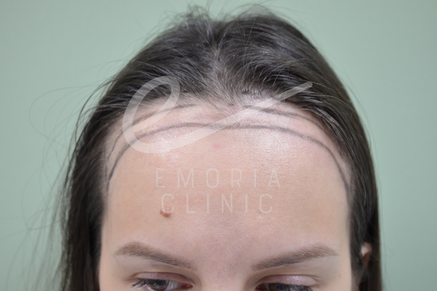 Female Hair Transplant Patient