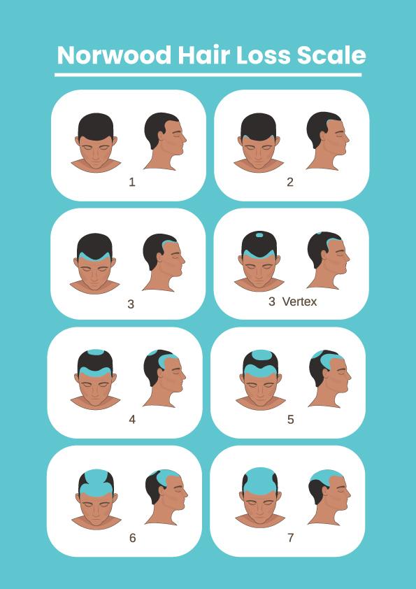 How Many Hair Grafts Do I Need? (Norwood Scale)
