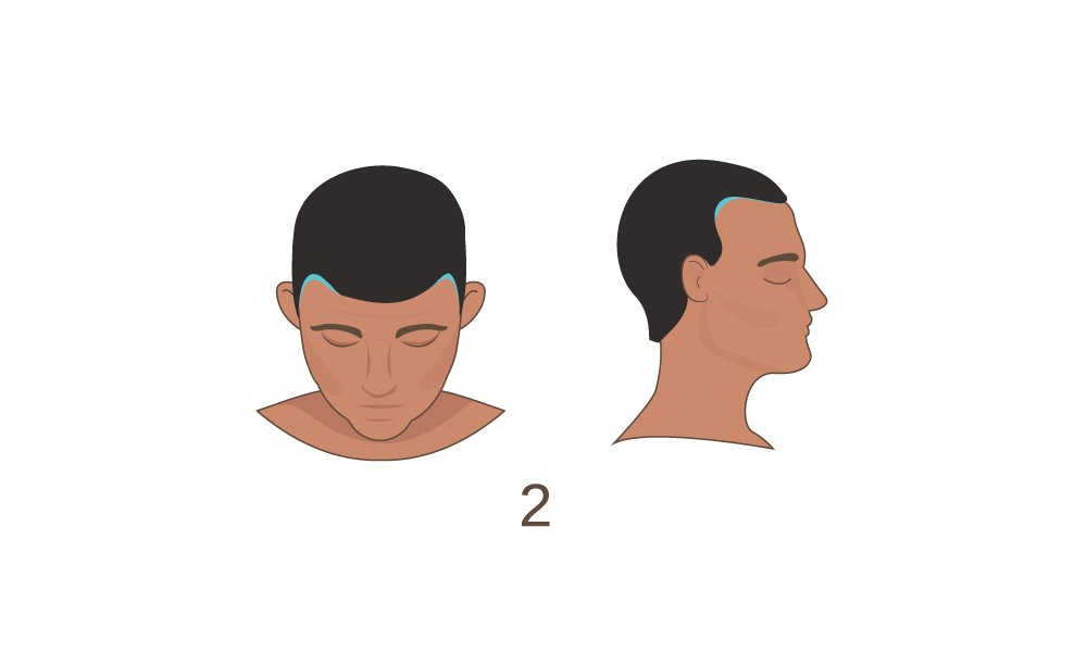 Norwood Scale Stage 2