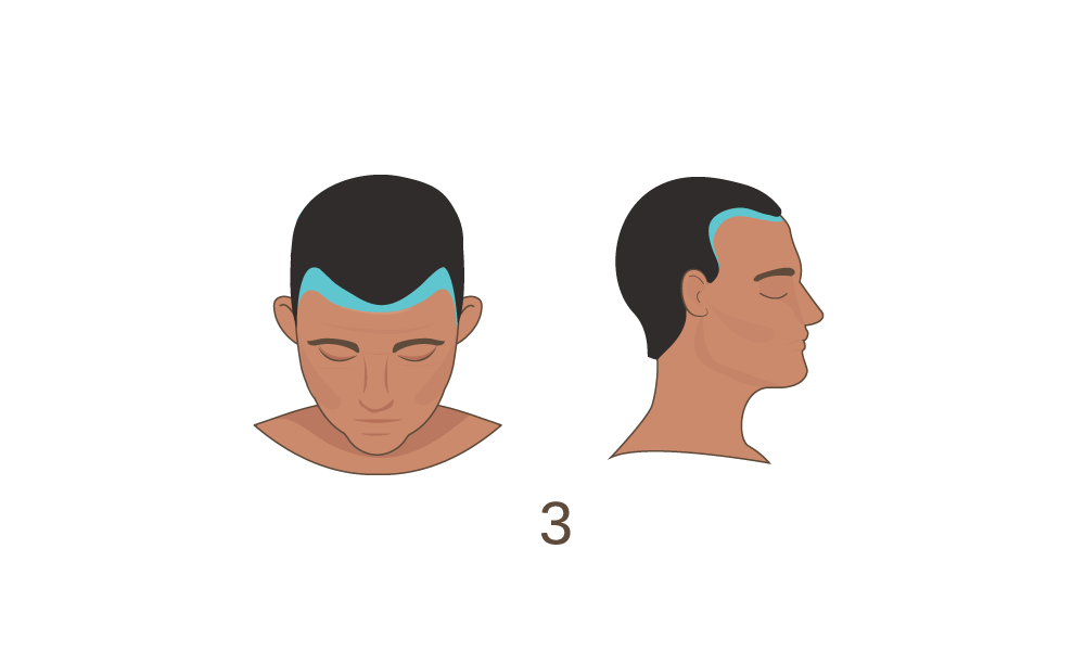 Norwood Scale Stage 3