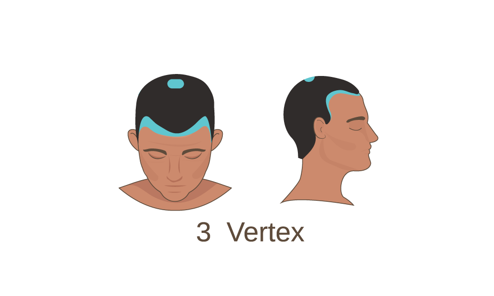 Norwood Scale Stage 3-Vertex
