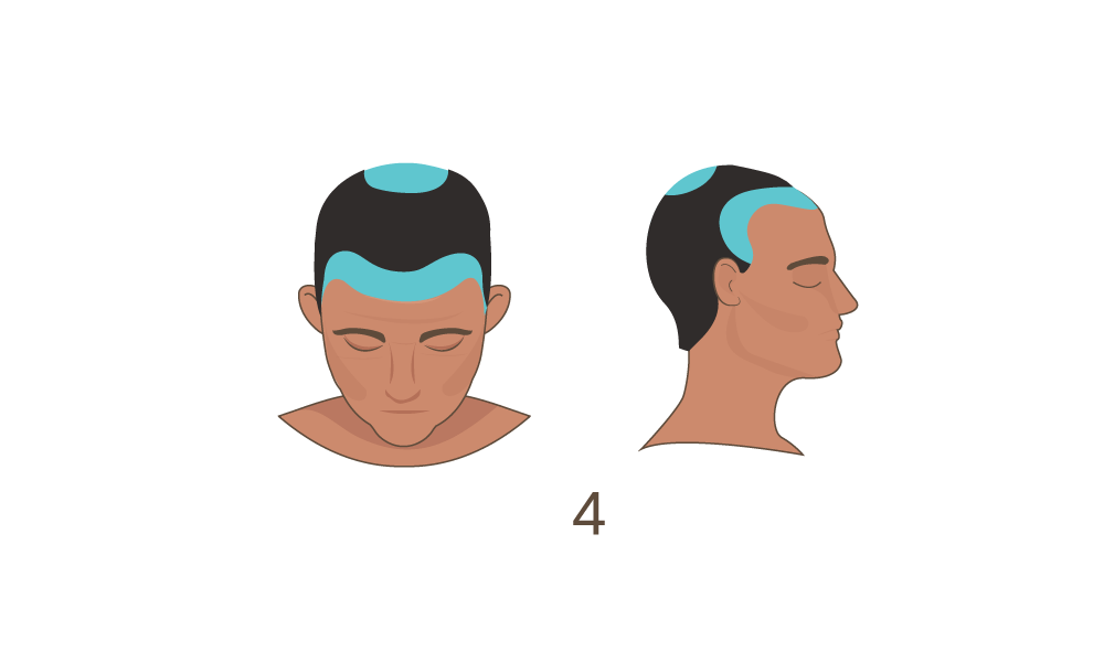 Norwood Scale Stage 4