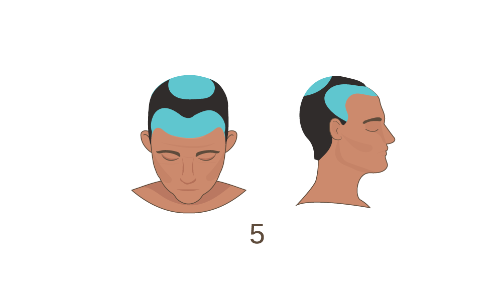 Norwood Scale Stage 5