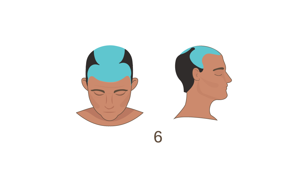 Norwood Scale Stage 6
