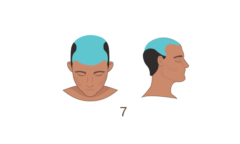 Norwood Scale Stage 7