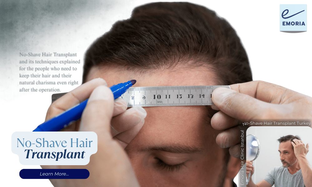 U-FUE (Unshaven) Hair Transplant in Turkey