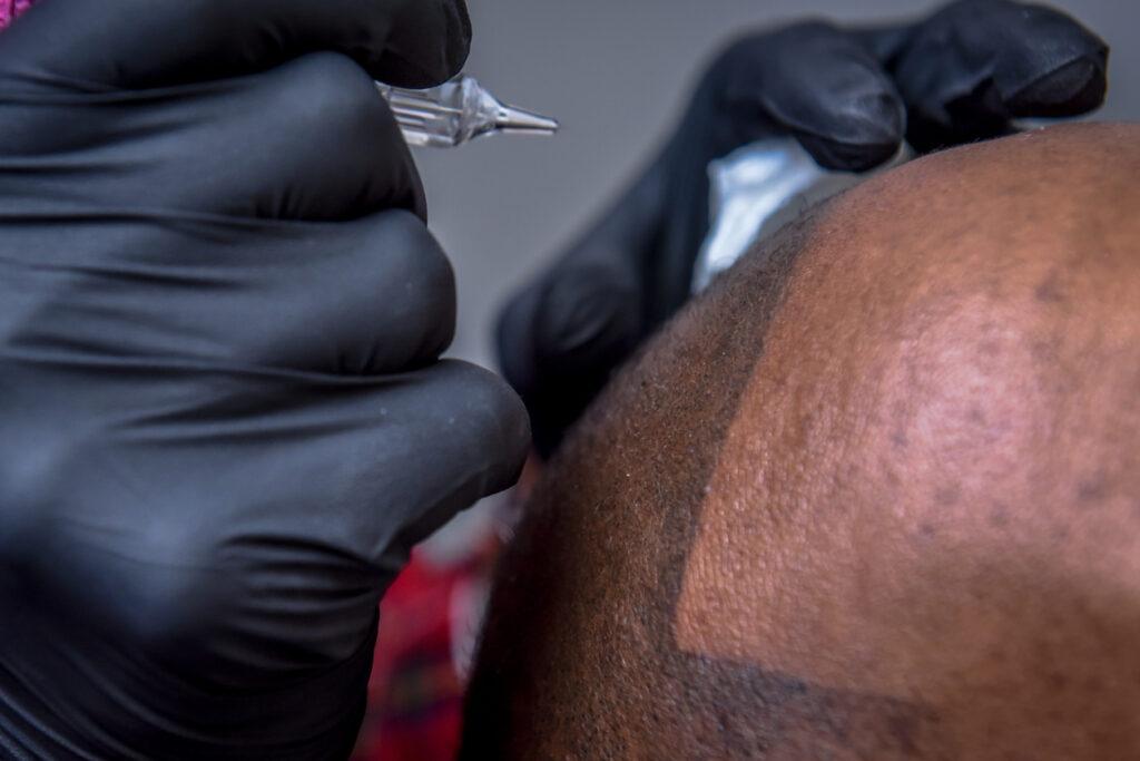 Black Male Patient during Scalp Micropigmentation (Hair Tattoo)